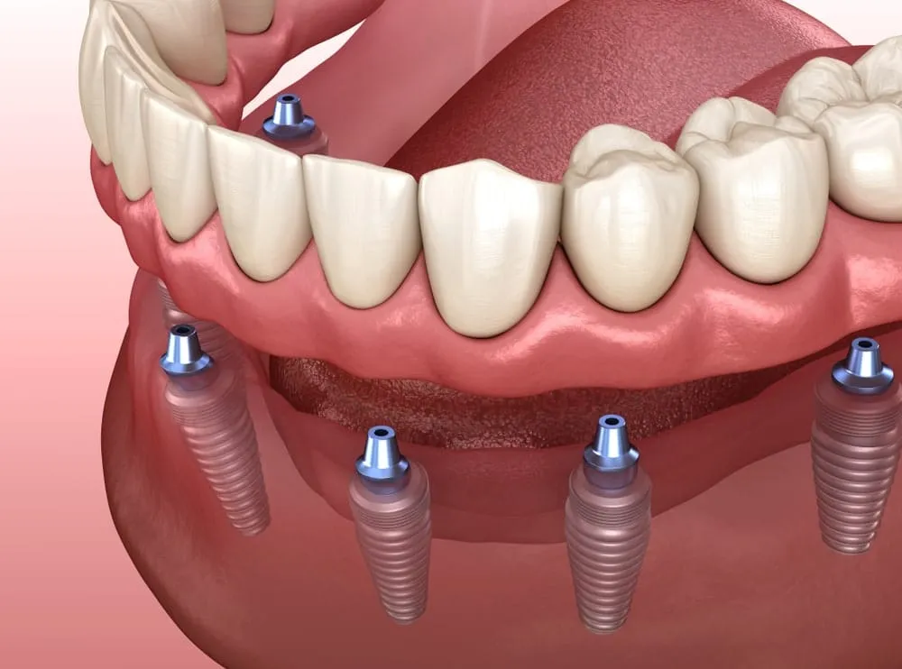 Implants dentaires en titane insérés dans la mâchoire inférieure pour remplacer plusieurs dents manquantes avec prothèse fixée