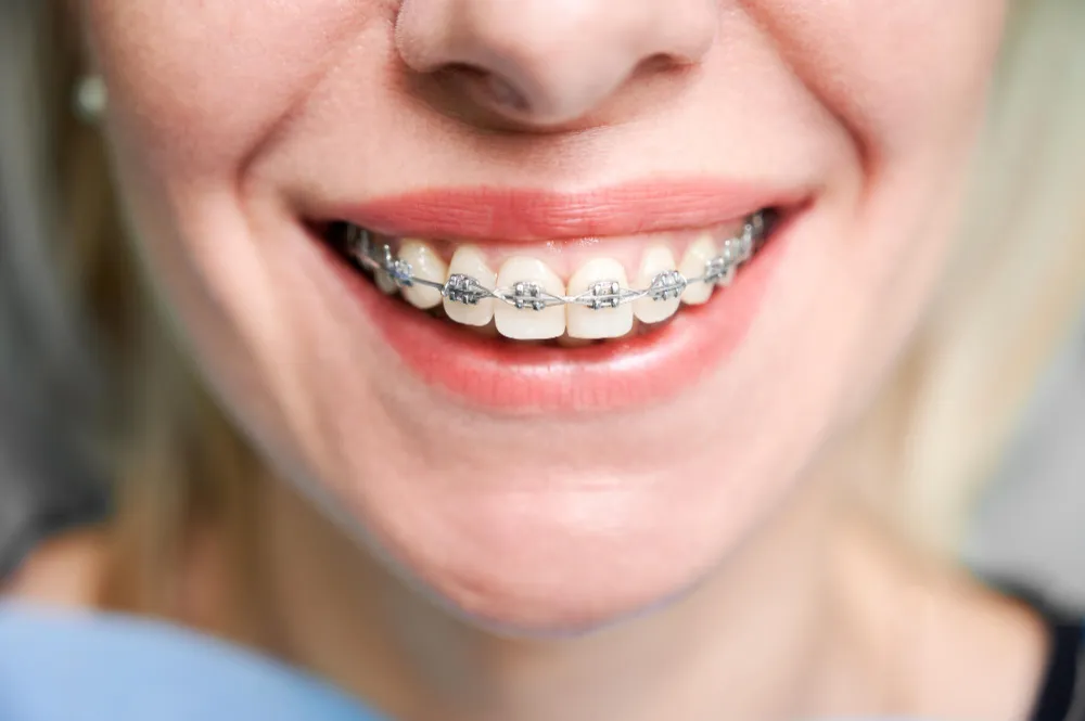 Gros plan d’un sourire montrant des dents équipées d’un appareil orthodontique métallique, illustrant un traitement d’orthodontie en cours pour l’alignement dentaire.