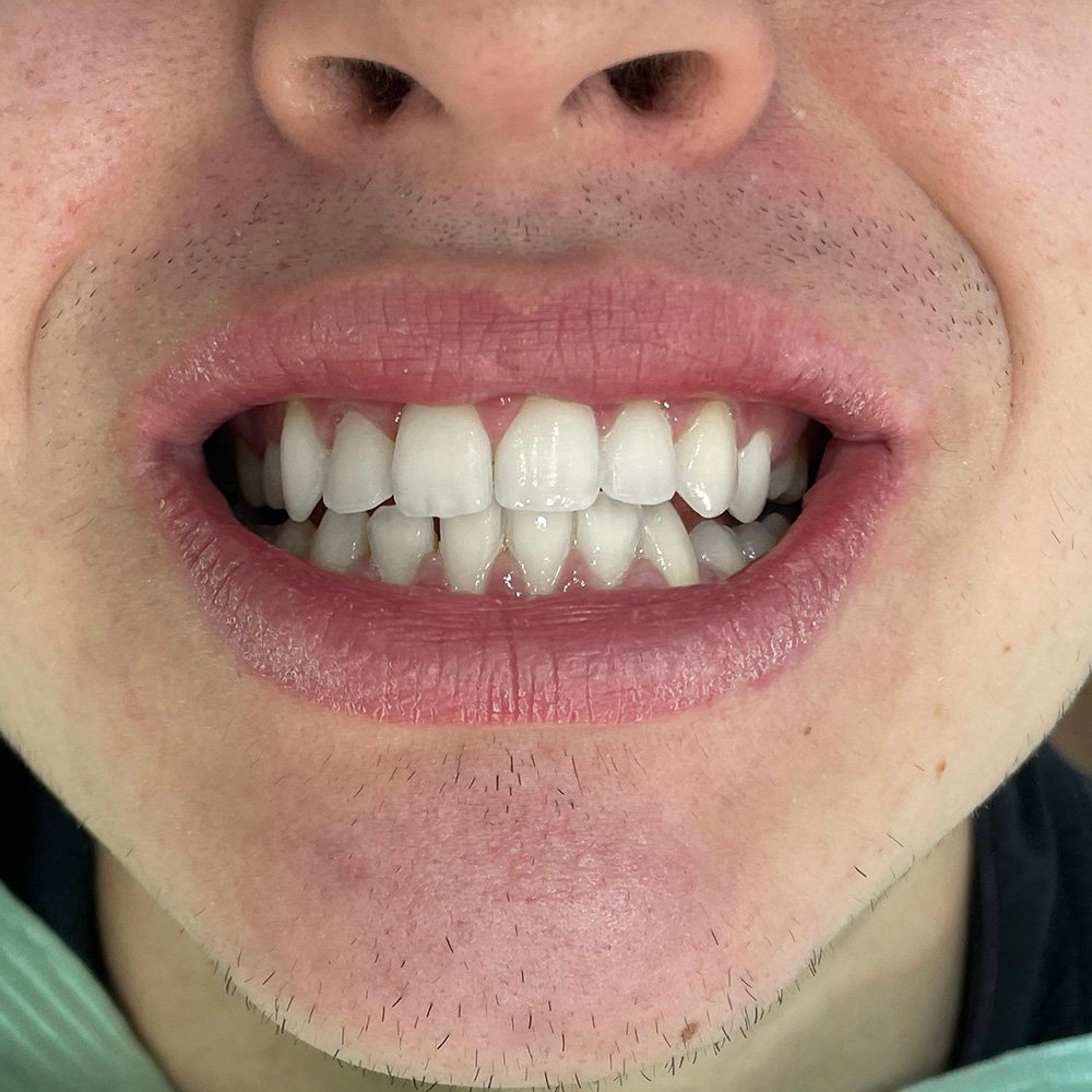 Blanchiment des dents | cabinet dentaire tanger Divina