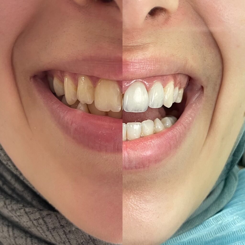 Blanchiment dentaire à Tanger avec comparaison avant après et guide de teinte pour un sourire plus blanc chez Divina Dental Center
