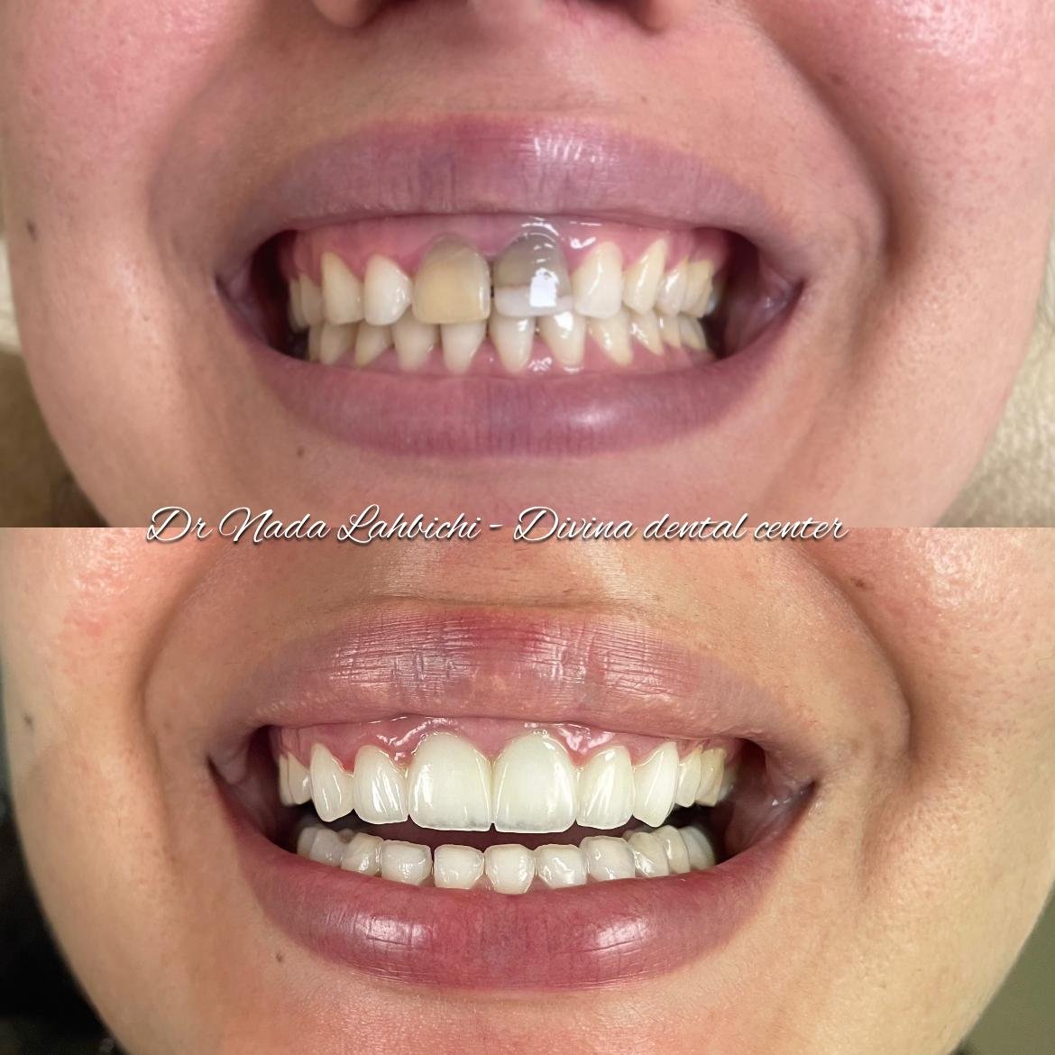 Avant et après un traitement dentaire - Nada lahbichi
