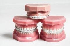 Différents modèles de bagues dentaires orthodontiques utilisés pour aligner les dents progressivement
