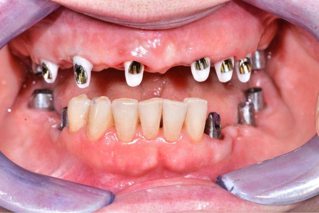 Pose de prothèses fixes sur implants avec piliers implantaires visibles avant la mise en place de la restauration dentaire complète.
