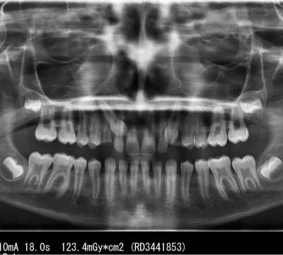 Radiographie panoramique dentaire montrant l’ensemble des dents, des mâchoires et des racines dentaires pour un diagnostic complet en cabinet dentaire.