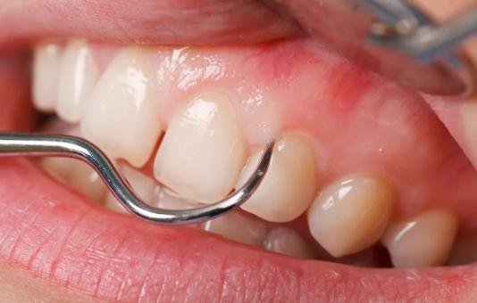 Examen des gencives lors de soins parodontaux avec un instrument dentaire dans un cabinet spécialisé à Tanger.