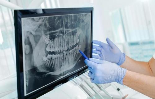 Radiographie panoramique analysée par un professionnel dentaire dans le cadre d’un projet d’implant dentaire, permettant d’évaluer l’état des dents, de l’os de la mâchoire et des zones d’implantation.