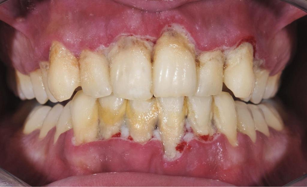 Accumulation importante de tartre et inflammation des gencives observées lors d’un examen de maladie parodontale avancée.