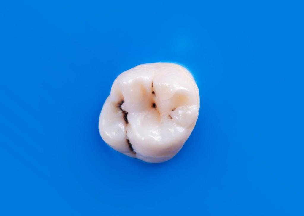 Dent présentant une carie dentaire visible sur les sillons occlusaux avec zones de déminéralisation et atteinte de l’émail.