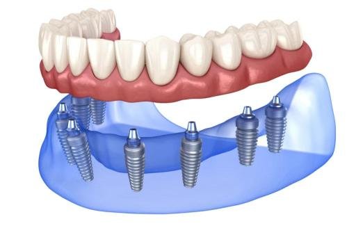 Illustration 3D d’un bridge complet sur implants dentaires montrant plusieurs implants fixés dans la mâchoire pour soutenir une prothèse dentaire complète.