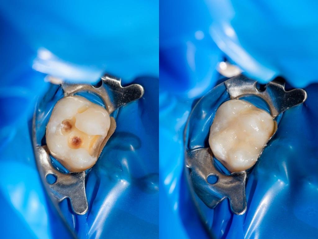 Comparaison avant et après traitement d’une carie dentaire avec restauration esthétique en composite sur une molaire isolée.
