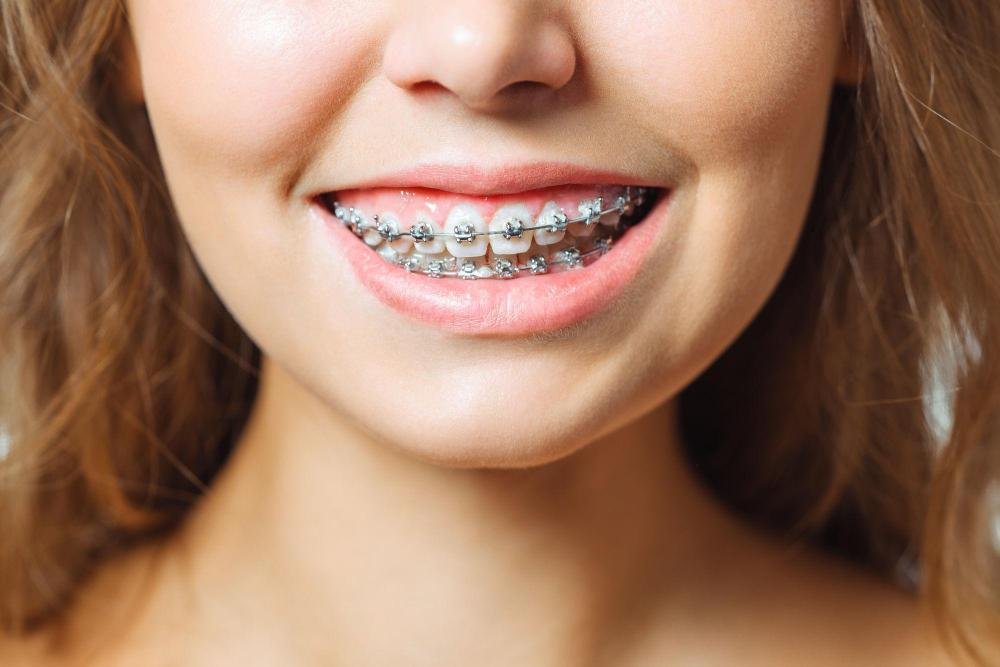 Jeune patiente souriante portant un appareil dentaire orthodontique métallique pour l’alignement des dents et la correction du sourire.