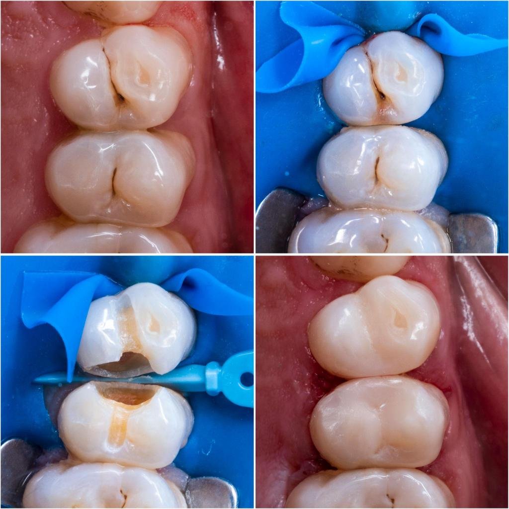 Étapes du traitement d’une carie dentaire avec nettoyage, préparation et restauration de la dent par composite esthétique.