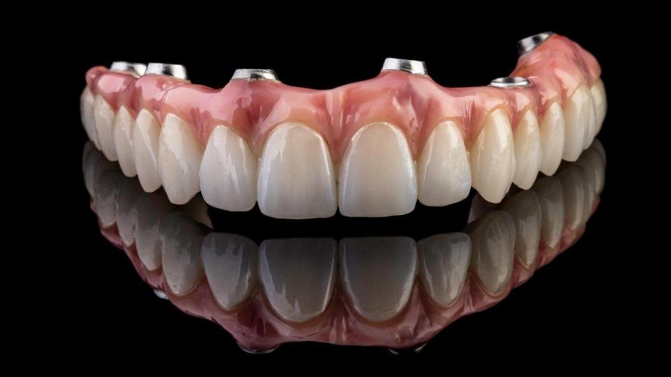 Prothèse dentaire fixe complète sur implants avec gencive artificielle et dents en céramique utilisée pour une réhabilitation orale complète.