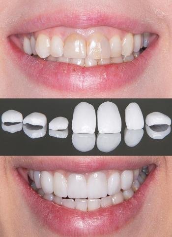Facette Dentaire Tanger – Avant/après de facettes dentaires en céramique avec amélioration esthétique du sourire.
