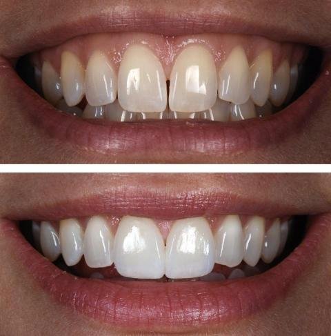 Esthétique Dentaire Tanger – Résultat avant/après d’un blanchiment dentaire professionnel avec amélioration visible de la couleur des dents.