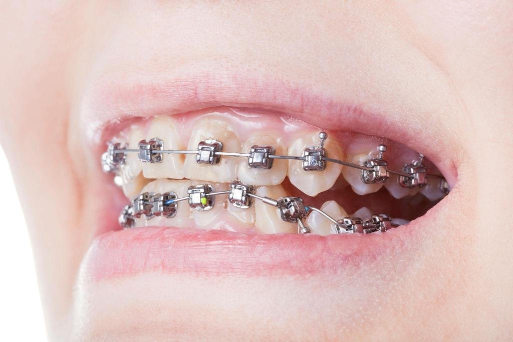 Bagues dentaires métalliques utilisées pour corriger l’alignement des dents et les problèmes d’occlusion