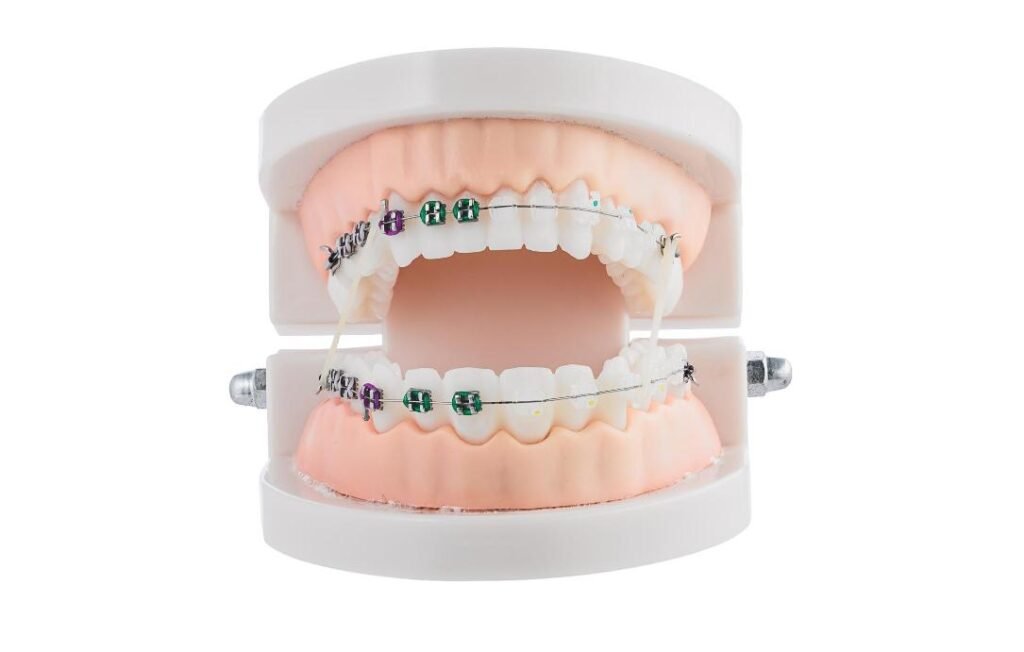 Modèle orthodontique avec bagues dentaires colorées illustrant le fonctionnement d’un appareil fixe