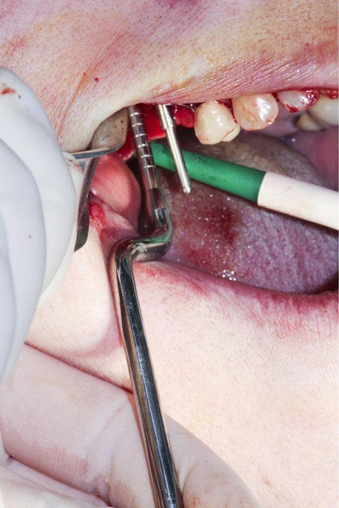 Intervention de chirurgie dentaire avec pose d’implant et instruments chirurgicaux dans un cabinet spécialisé en implantologie.