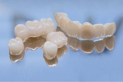 Prothèses dentaires fixes en céramique utilisées pour la restauration et le remplacement des dents en dentisterie esthétique.