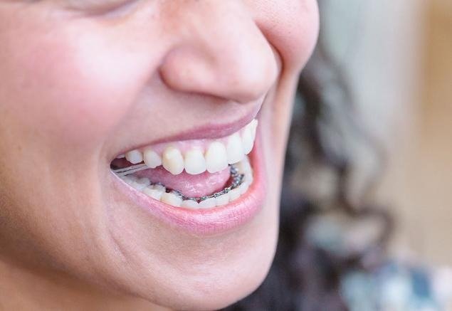 Sourire avec appareil dentaire adulte fixé sur les dents inférieures, traitement orthodontique discret pour corriger l’alignement dentaire et améliorer l’occlusion.