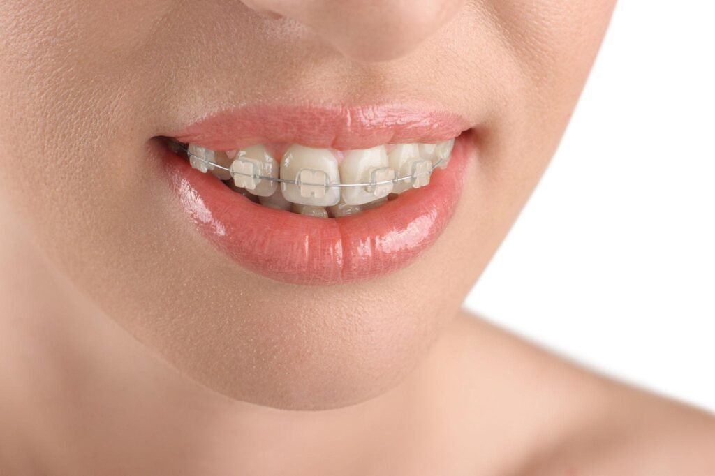 Appareil dentaire adulte avec bagues transparentes en céramique sur les dents supérieures, sourire naturel et alignement orthodontique discret.
