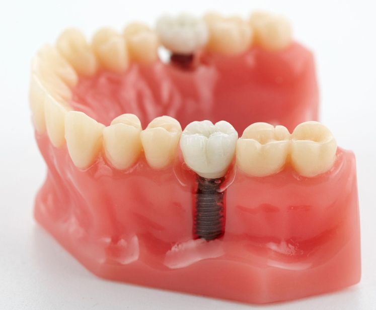 Modèle d’implant dentaire avec couronne fixée sur une vis implantaire intégrée dans la mâchoire, illustrant le remplacement d’une dent manquante par une solution prothétique fixe.