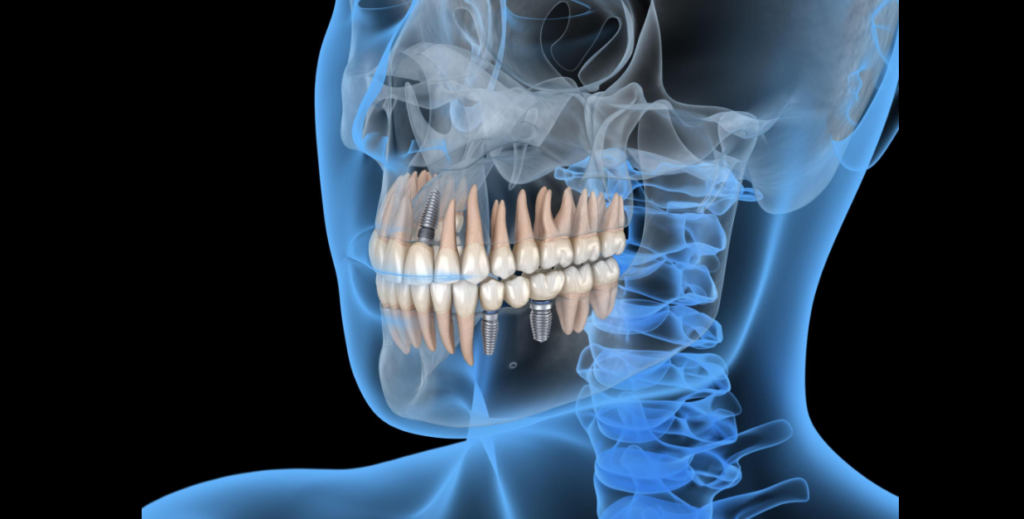 Illustration 3D montrant plusieurs implants dentaires intégrés dans l’os de la mâchoire, utilisés pour remplacer des dents manquantes et soutenir des couronnes dentaires fixes.