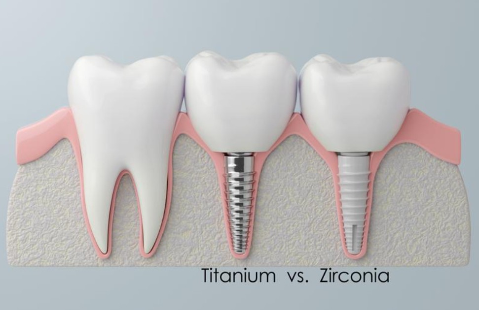 Comparaison entre différents types d’implant dentaire, montrant une dent naturelle, un implant en titane et un implant en zircone, utilisés pour remplacer durablement une dent manquante.