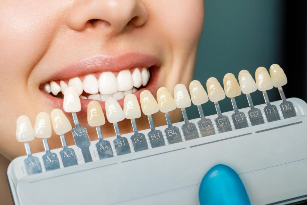 Résultat de blanchiment dentaire avec sourire éclatant et nuancier de teintes dentaires utilisé pour comparer l’éclaircissement et l’uniformité de la couleur des dents.