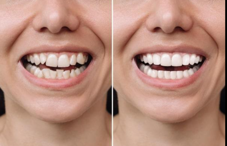 Comparaison avant après la pose de facettes dentaires pour améliorer la couleur, la forme et l’alignement du sourire.