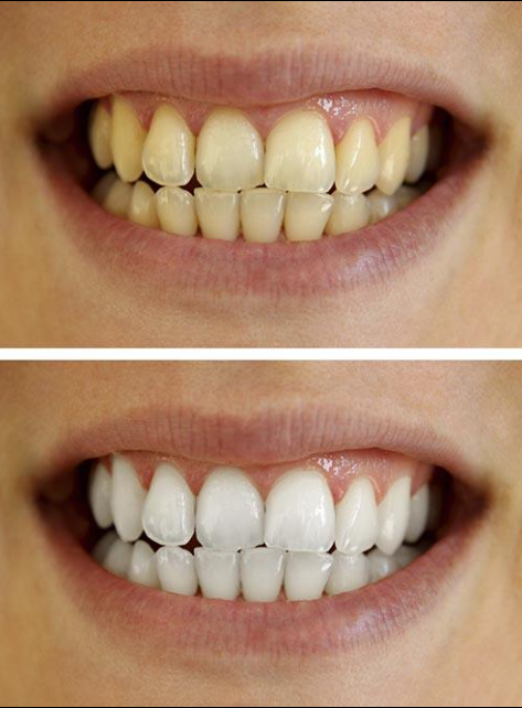 Comparaison avant et après blanchiment dentaire, montrant l’éclaircissement visible de la teinte des dents et l’amélioration de la blancheur du sourire après traitement.