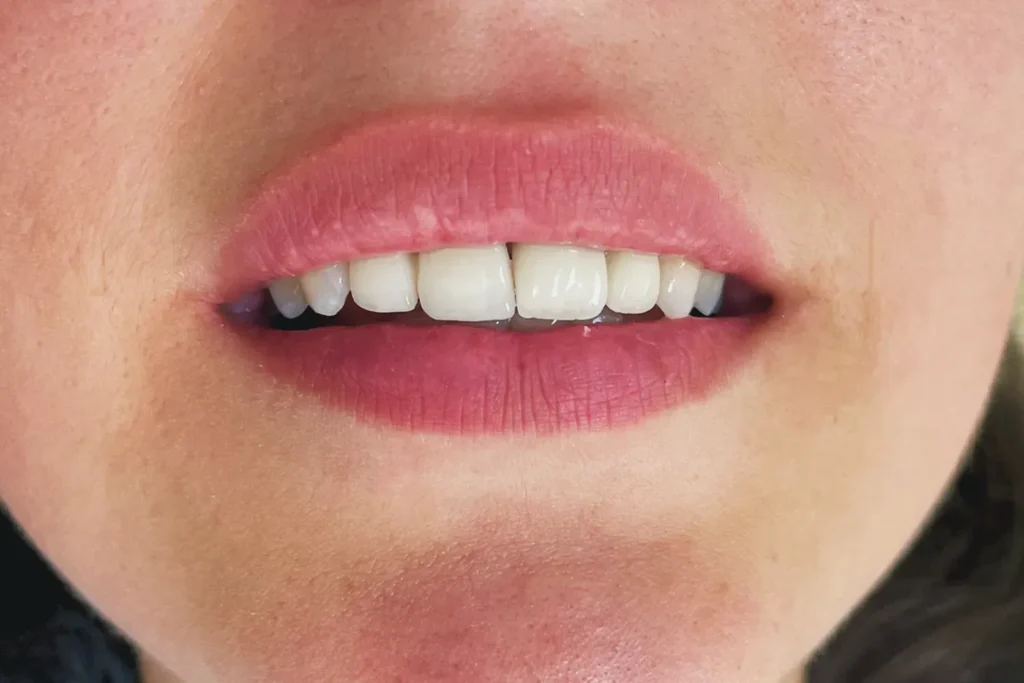 Résultat esthétique d’un implant dentaire à Tanger avec dents blanches, alignées et restauration naturelle du sourire dans une clinique dentaire moderne.