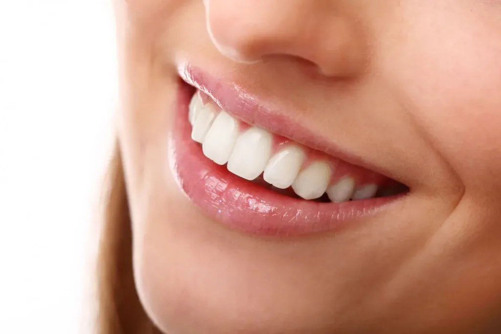Blanchiment dentaire à Tanger avec sourire éclatant et dents blanches naturelles après soin esthétique professionnel chez Divina Dental Center