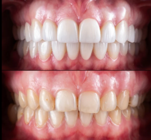 Comparaison avant et après la pose de facettes dentaires, montrant l’amélioration de la couleur, de la forme et de l’alignement des dents pour un sourire plus harmonieux et uniforme.