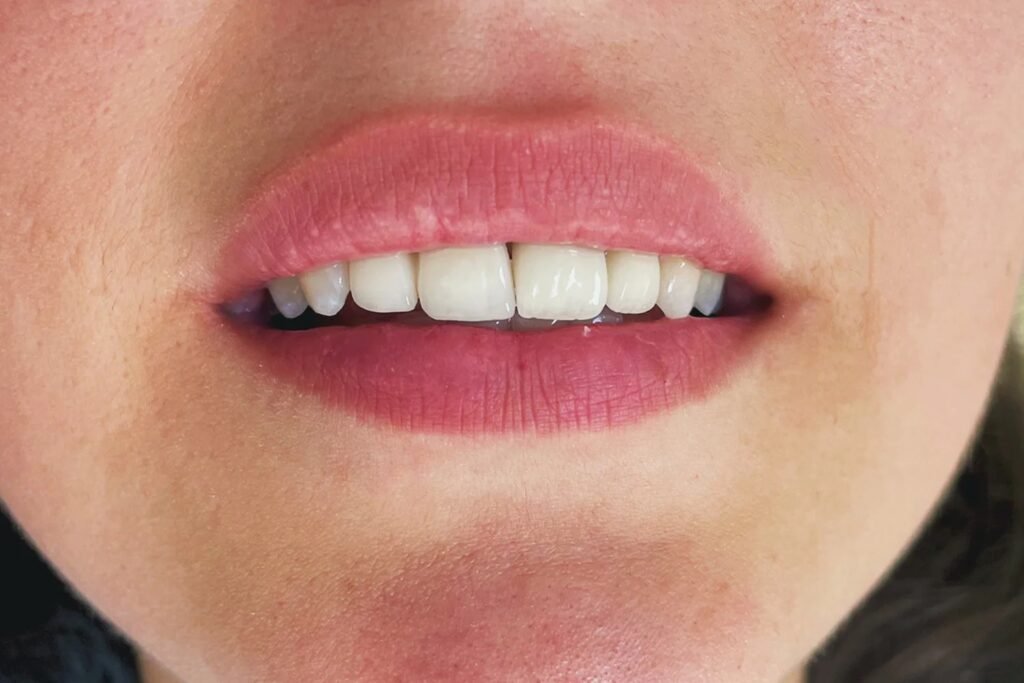 Facette Dentaire Tanger – Gros plan sur un sourire avec facettes dentaires en céramique au rendu naturel et harmonieux.