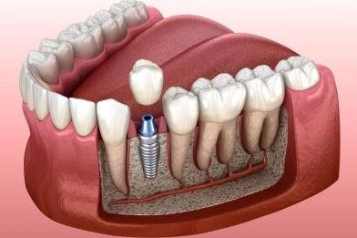 Illustration 3D d’un implant dentaire montrant la pose de l’implant dans l’os de la mâchoire avec couronne dentaire pour remplacer une dent manquante.