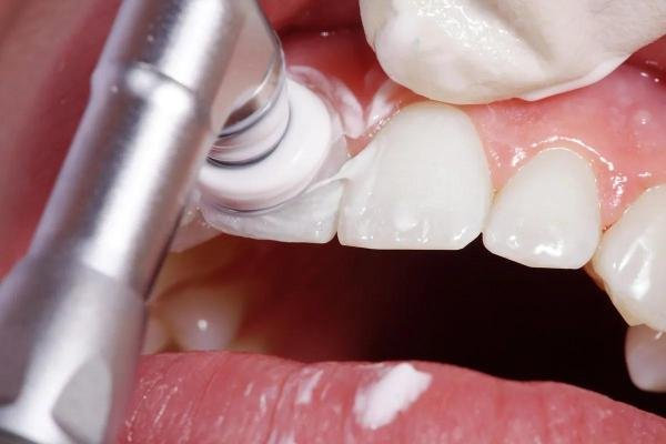 Polissage des dents après un détartrage professionnel pour lisser l’émail dentaire