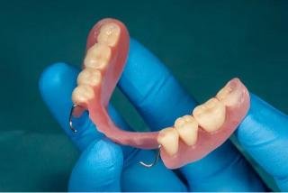 Prothèse dentaire amovible partielle tenue par un professionnel de santé pour le remplacement des dents manquantes.