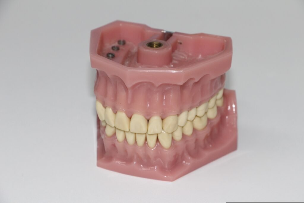 Modèle de prothèse dentaire complète avec structure implantaire utilisé pour la démonstration des solutions de réhabilitation orale fixe et amovible.