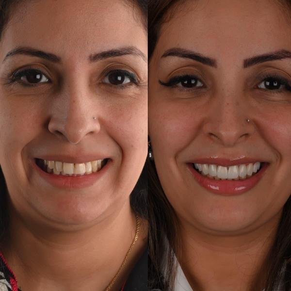 Esthétique Dentaire Tanger – Transformation du sourire avant/après grâce à des soins esthétiques dentaires et un blanchiment professionnel.