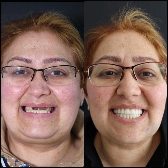 Transformation avant et après Hollywood Smile avec facettes dentaires et restauration esthétique du sourire pour améliorer l’alignement et la couleur des dents.