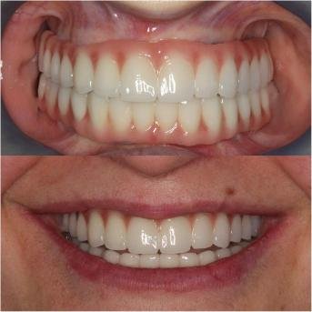Résultat esthétique de prothèses fixes sur implants avec réhabilitation complète du sourire et restauration des dents.