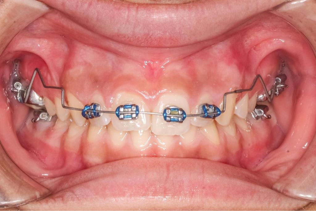 Gros plan sur un appareil orthodontique métallique fixé sur les dents pour corriger l’alignement dentaire et la malocclusion.