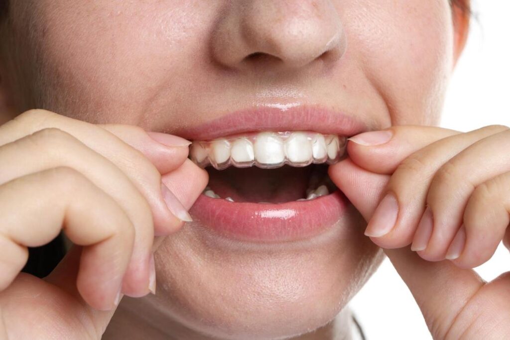 Patient mettant en place une gouttière dentaire transparente pour corriger l’alignement des dents