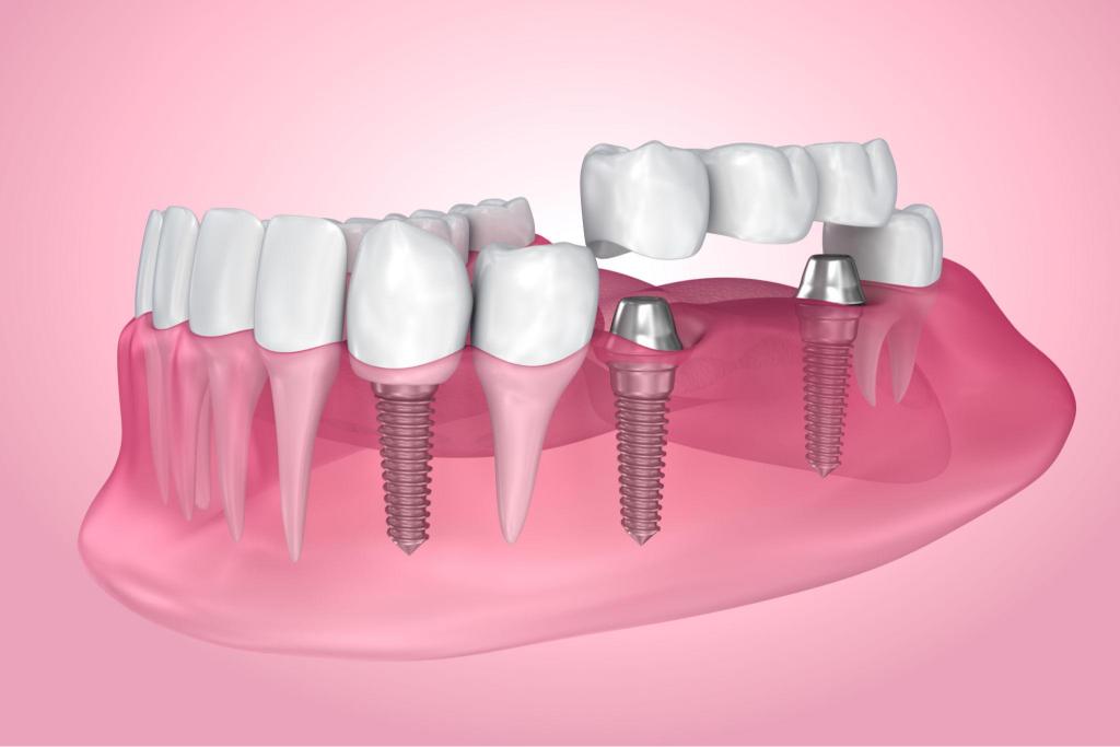 Schéma 3D d’un bridge dentaire soutenu par des implants dentaires pour retrouver un sourire complet