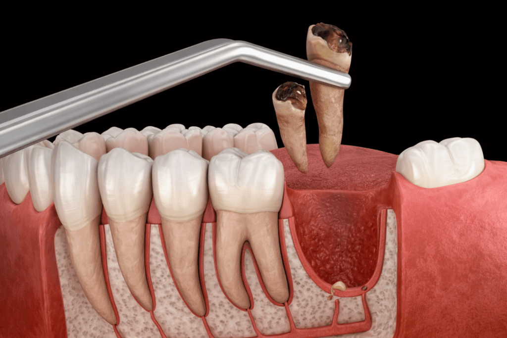 Extraction dentaire réalisée au Divina Dental Center à Tanger