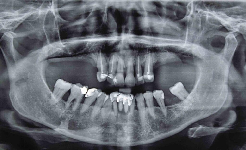 Radiographie panoramique dentaire montrant les dents et les soins déjà réalisés