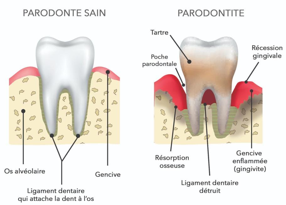 Schéma comparant un parodonte sain et une parodontite avec gencive enflammée