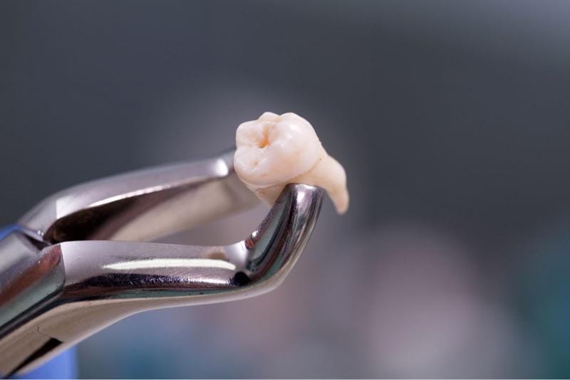 Schéma expliquant l'extraction d'une dent abîmée