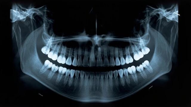 Cliché de radio panoramique dentaire montrant l'ensemble des dents et des mâchoires